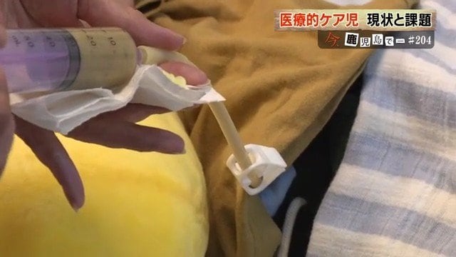 腹部に設けた管から食事を摂取する 瑛斗くん