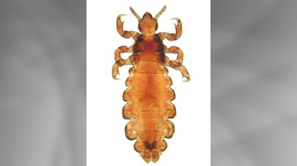 【アタマジラミに注意】子どもの髪に寄生し血を吸って強いかゆみを引き起こす― 1日に8個も産卵しどんどん増えて人から人へうつる“コロナ禍”以降再び増加〈皮膚科に聞く対策〉