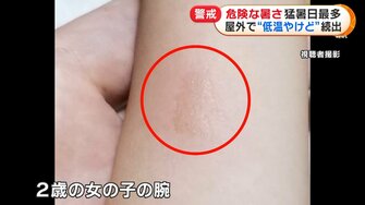 遊具やベランダの手すりに触れ 低温やけど スマホ熱中症 で故障も 猛暑に気をつけるべきポイントと対処法