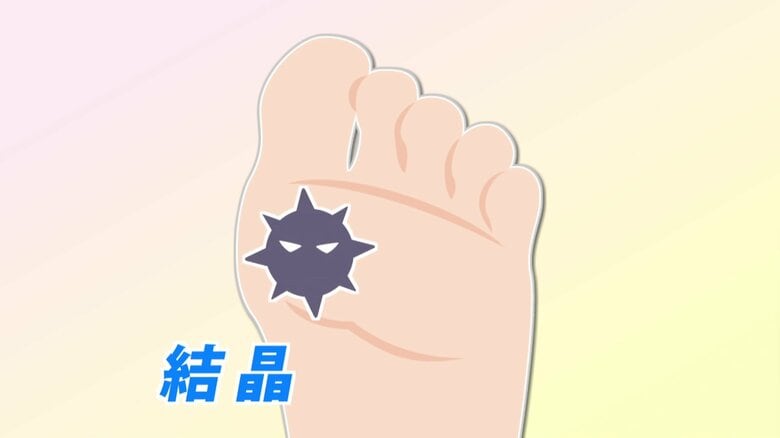 尿酸が関節の中で結晶化し痛みに