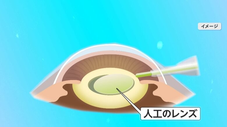 イメージ：人工のレンズを入れる