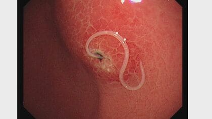 アニサキス“10匹以上”いた人も…幼虫が胃や腸に刺さり激痛　感染患者語る「二度となりたくない」