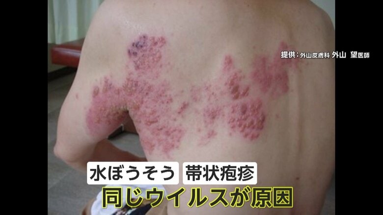 【警戒】「感染力インフルエンザやコロナより強い」水ぼうそう異例の大流行…埼玉県で初の流行注意報発令　同じ水痘ウイルス「帯状疱疹」からの感染も増｜FNNプライムオンライン