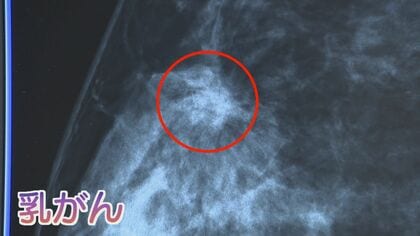 日本人女性の8人に１人が罹患 年間約10万人の乳がん患者 術後にジムで支援 社会復帰をサポート 入院期間の短縮でリハビリ重要に 【福岡発】
