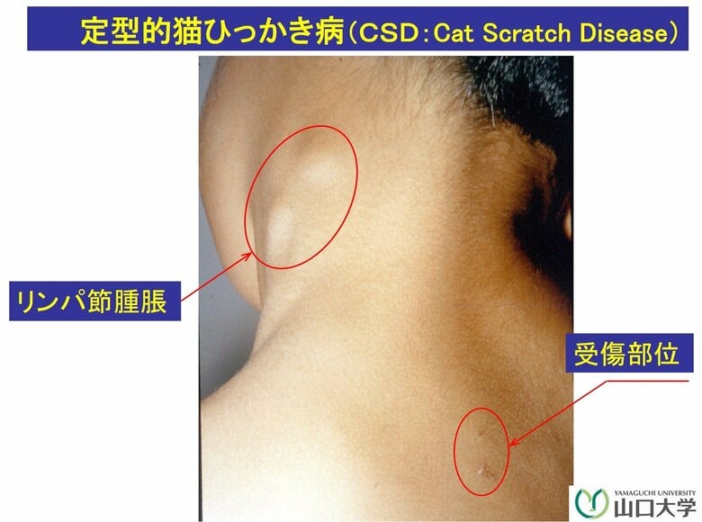 猫ひっかき病による症状の例（提供：山口大学）