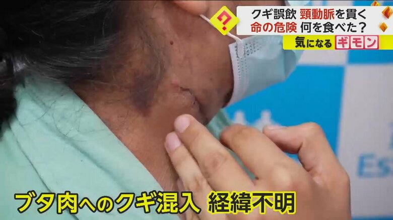 喉にクギが刺さっていた女性の手術後の患部の様子