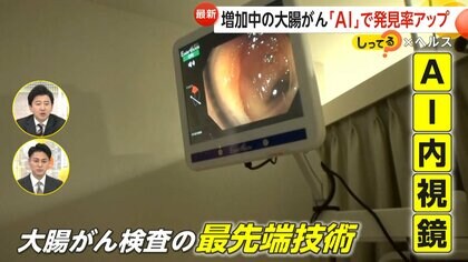 がん発見率が“7〜10％向上”…増加中の大腸がん発見する「内視鏡AI」　40歳から内視鏡検査を推奨…検査費は保険適用に【しってる？】