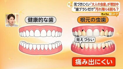 気づきにくい「大人の虫歯」“歯ブラシだけ”汚れ残り4割　歯科医が伝授する持ち方やすすぎ方、ブラシの選び方も