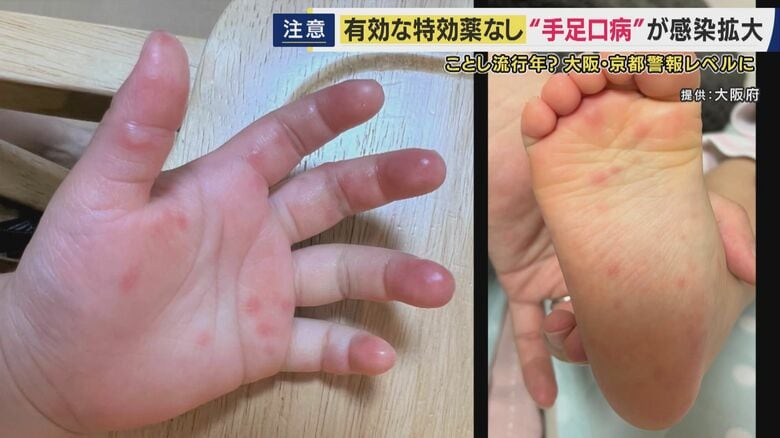 保育現場では感染拡大対策で「洗えない絵本やパズルは紫外線で殺菌」も　全国で「手足口病」が流行　大阪・京都でも警報レベルに　特効薬ない中で対策は「しっかり手洗い・タオルの共有を避ける」｜FNNプライムオンライン