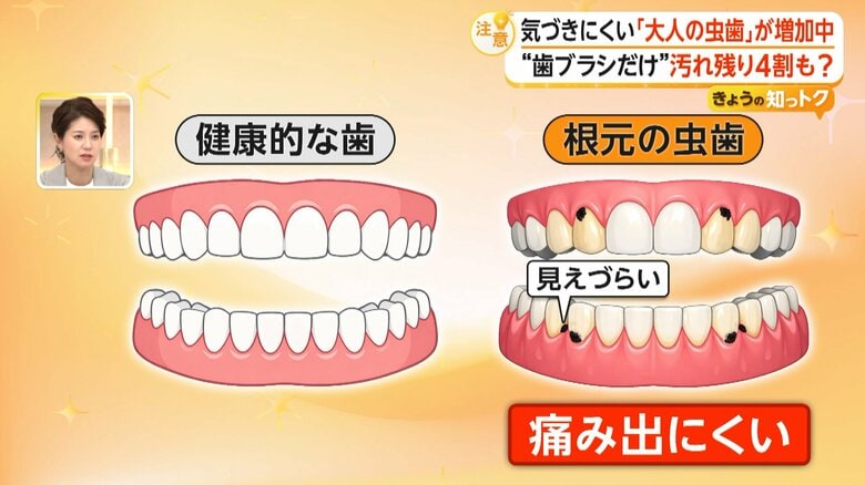 気づきにくい「大人の虫歯」“歯ブラシだけ”汚れ残り4割　歯科医が伝授する持ち方やすすぎ方、ブラシの選び方も｜FNNプライムオンライン