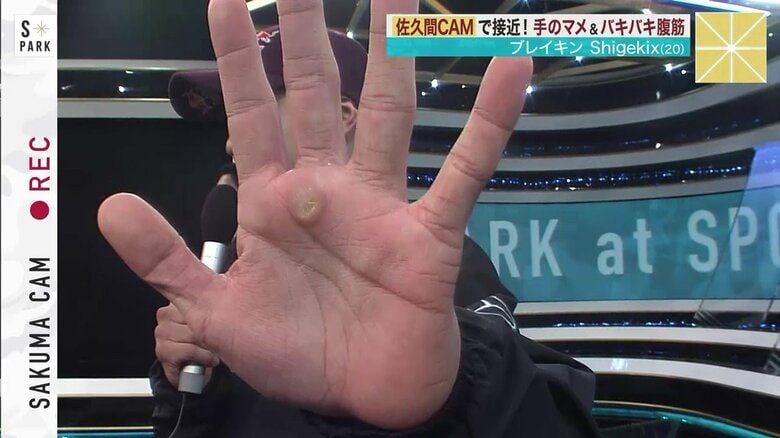 Shigekixの左手のマメ