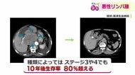 ステージ4でも「治癒が期待できる」悪性リンパ腫　10年後生存率は80％超　がん細胞を“狙い撃ち”する注目の治療法