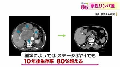 ステージ4でも「治癒が期待できる」悪性リンパ腫　10年後生存率は80％超　がん細胞を“狙い撃ち”する注目の治療法