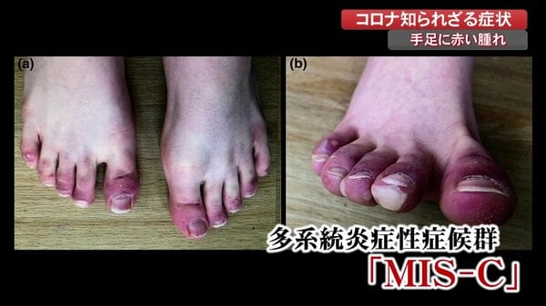 コロナ感染した子どもに 手足の腫れ 血管が炎症 悪化すると心筋炎や心筋梗塞の恐れも 高知発