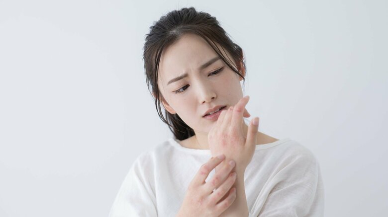 アニサキスアレルギーではじんましんが出る場合もあるという（画像はイメージ）