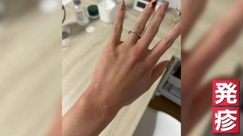 （手の甲にに出た寒冷じんましんの症状）