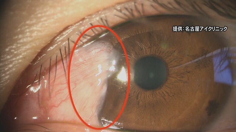 白内障など発症する恐れ…紫外線による“目の日焼け”の怖さ 白目が黒目部分まで伸びる病気を30代でも確認｜FNNプライムオンライン