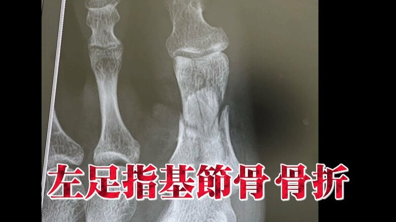 （左足指基節骨　骨折のエックス線写真　安井友梨公式インスタグラムより）