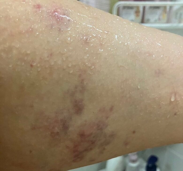 2024年10月、男性客からホテルの一室で暴行を受け残った痣（あざ）