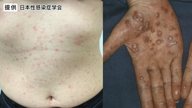 提供：日本性感染症学会
