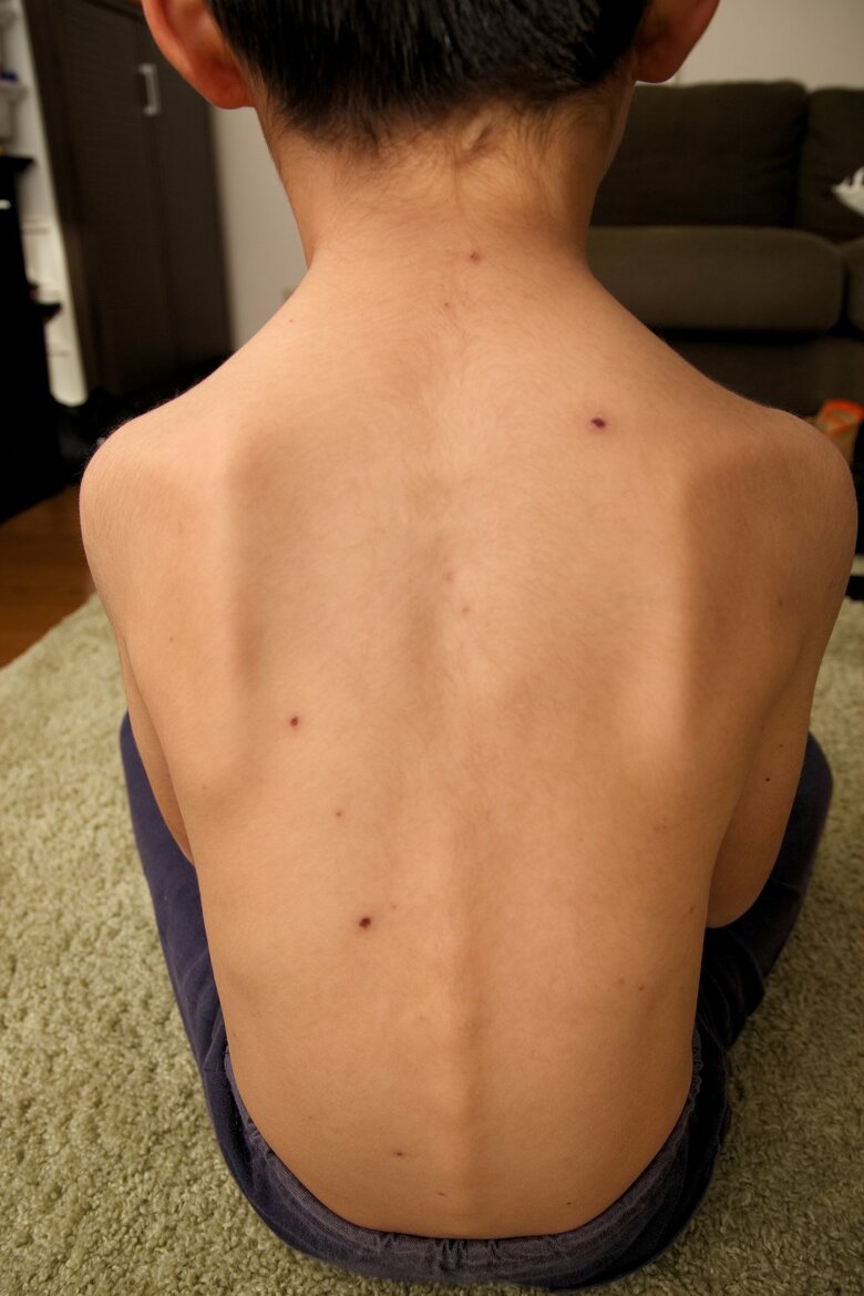 水ぼうそうの子ども