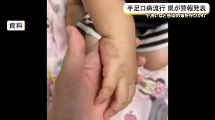 手足口病流行　沖縄県が警報発表し感染対策を呼びかけ