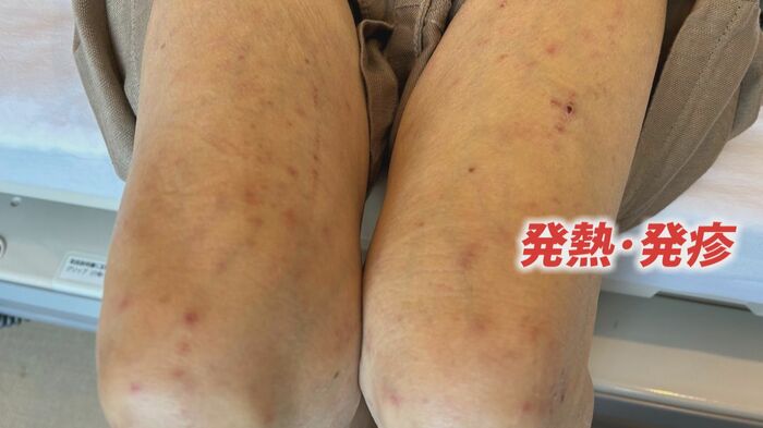 刺されたマダニが微生物をもっていると感染する