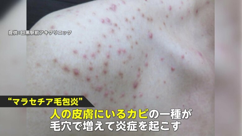 【注意喚起】カビで皮膚が炎症…患者激増の「マラセチア毛包炎」大雨と蒸し暑さ繰り返す今年の梅雨は特に注意！｜FNNプライムオンライン
