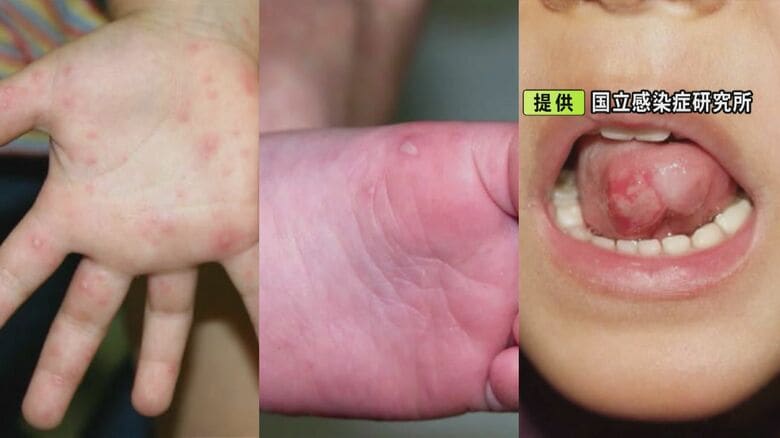 ワクチンや治療薬なく…子供を中心に流行中の『手足口病』症状が収まった後もウイルスの排泄続き大人も注意|FNNプライムオンライン