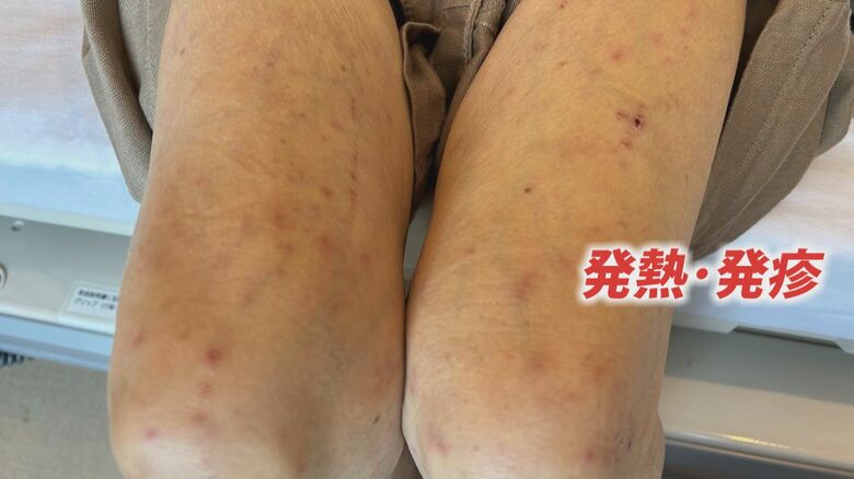 刺されたマダニが微生物をもっていると感染する
