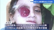 「誰もヒロシマの悲劇を望んでいない」 今も劣化ウラン弾の影響に苦しむイラクの子どもたち… 現地の医師が語る　