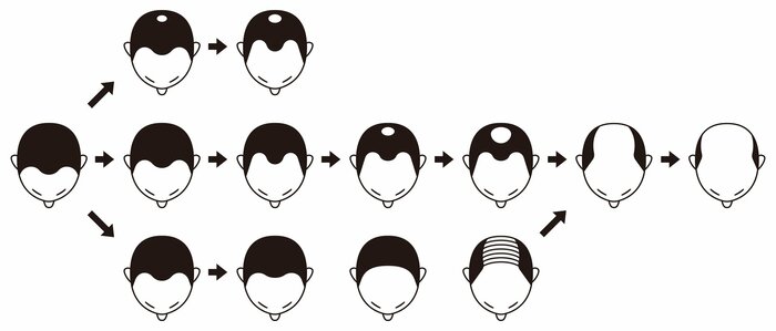 AGAには様々なタイプがある