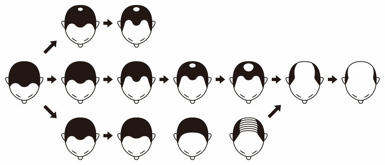 AGAには様々なタイプがある