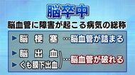 身近な病気「脳卒中」予兆を見流さない合言葉「FAST」素早い治療…