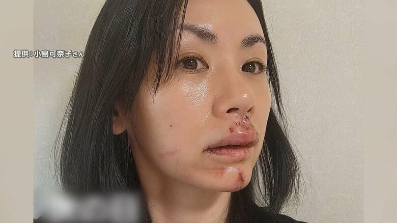 医師「傷跡が結構残る」元グラビアアイドル・小島可奈子さん（49）が犬に顔をかまれ30針を縫うけが「犬は悪気ない」｜FNNプライムオンライン