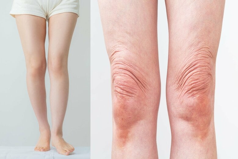 健康な膝（左）と衰えている膝（右）（画像はイメージ）