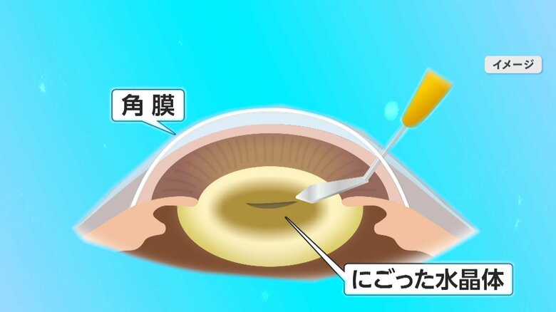イメージ：濁った水晶体を取り出す
