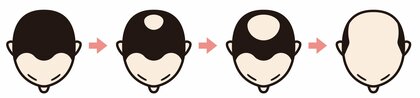 “薄毛を克服した”男女800名に調査。30%以上がクリニックで治療!薄毛に悩む方へのアドバイスは「あきらめたらそこで試合終了」