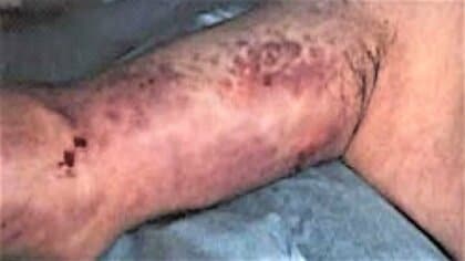 感染から数時間で「壊死」死に至ることもある『人食いバクテリア』30代以上・基礎疾患あり免疫力落ちて傷口あると要注意【専門家解説】