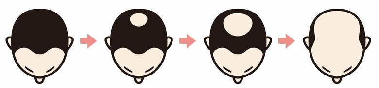 “薄毛を克服した”男女800名に調査。30%以上がクリニックで治療!薄毛に悩む方へのアドバイスは「あきらめたらそこで試合終了」
