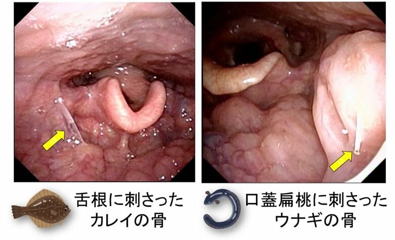 魚の骨が刺さった様子　（画像提供：東北大学大学院医学系研究科　耳鼻咽喉・頭頸部外科学分野 鈴木淳講師）
