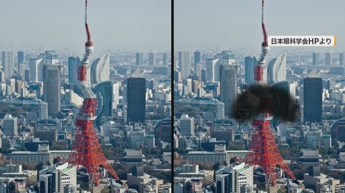 加齢黄斑変性の患者の視野（イメージ）
