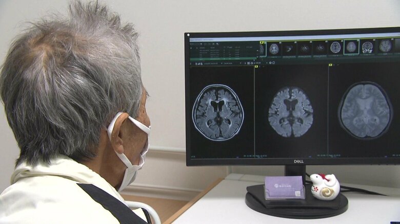 認知症は“早期の診断”が重要 進行すると治療方法も制限 物忘れを歳のせいにして放置すると症状進み治療も困難に｜FNNプライムオンライン