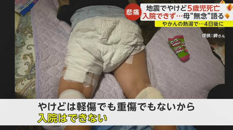 やけどはお尻や両足など広範囲に及んでいた
