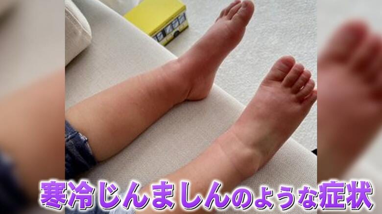 (2歳の子どもの足にも…)