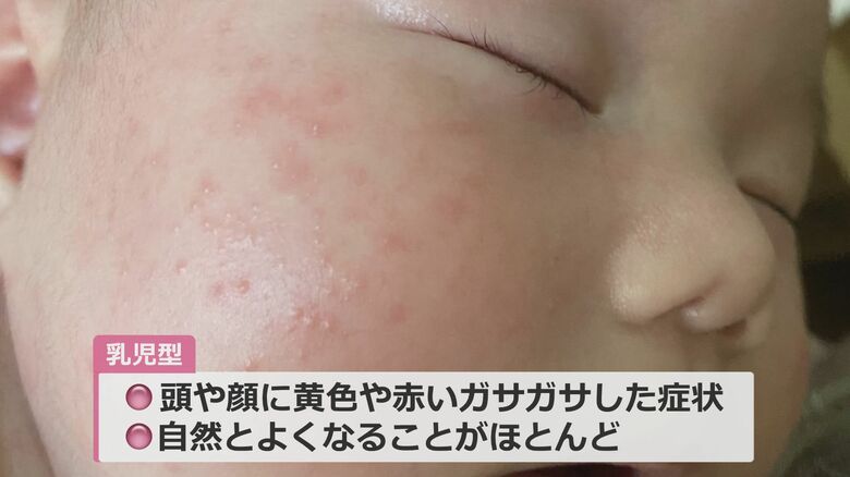 乳児型は自然に改善することが多い