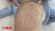 心臓に後遺症も…5日以上続く熱は要注意！乳幼児の「川崎病」　目や舌に出る症状や受診の目安を医師が解説　　