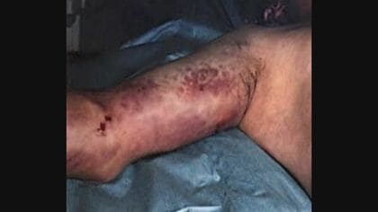 「人食いバクテリア」過去最多の患者数「死に至る感染症」引き起こすこともある「溶連菌」 感染抑える薬を発見