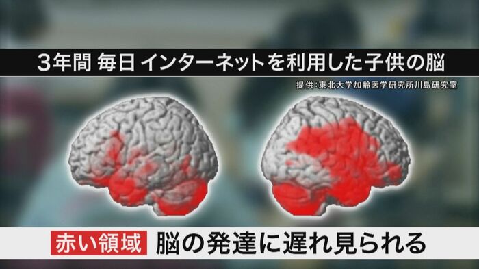 3年後に同じ子どもの左右の脳を調査した画像。「赤い部分」が脳の発達に遅れが見られたところ。色が濃いほど遅れの傾向が強いことを示している