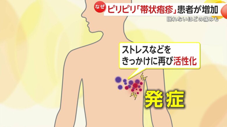 体内に残った水ぼうそうウイルスが、ストレスなどをきっかけに活性化し発症